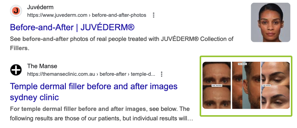 Google keyword search results for “face filler before and afters."